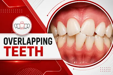 overlapping teeth